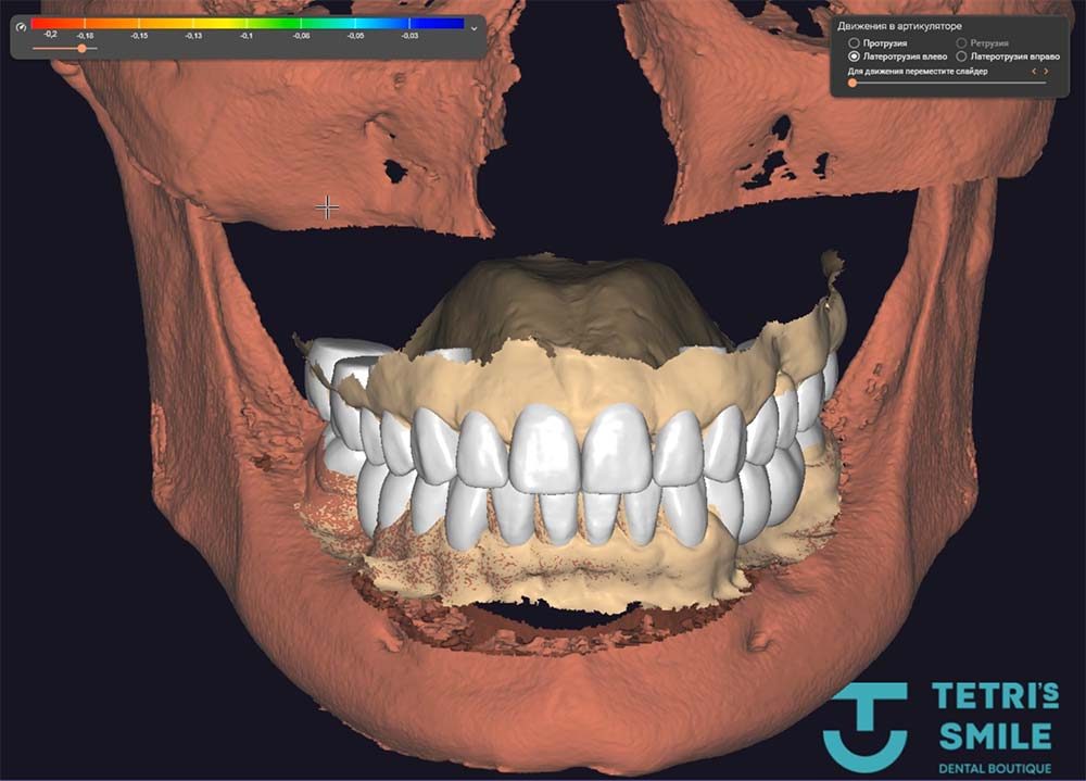 A digital smile design showing the planned teeth over the patient’s scan